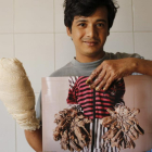 Abul Bajandar muestra una fotografía de cómo estaban sus manos antes de someterse a 16 operaciones en el Dacca Medical College en Bangladesh.