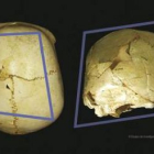 En la imagen puede apreciarse esta rara patología craneal, derivada de la fusión prematura de los hu
