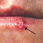 Herpes labial, causado por el virus simplex de tipo 1 (HSV-1)