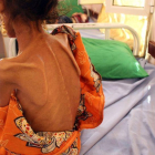 Una niña de 12 años con altos niveles de desnutrición en Yemen.
