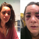 Andrea Sicignano  en dos fotografías publicadas por ella misma en su cuenta de Facebook tras la violación y agresión que sufrio en Aluche (Madrid).