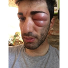 Danilo Cela tras la picada de un insecto