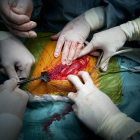 Varios cirujanos trabajan en una operación de transplante de riñón de un donante vivo