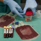 Una muestra de sangre de la que se extraen células madre.