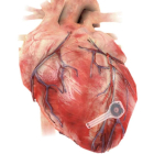 Ilustración del dispositivo sobre un corazón. Northwestern University