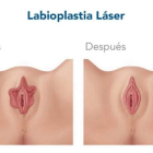 Imágenes que ilustran el antes y el después de una labioplastia y el uso del láser para intervenir en la zona genital. CENTRO GINECOLÓGICO HM SAN FRANCISCO