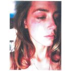 Amber Heard, con las heridas en el rostro que le causó Johnny Depp al lanzarle un teléfono.