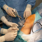 Hospital Universitari de Bellvitge  Una  nueva cirugia que  implanta tejido porcino puede revolucionar el tratamiento de rotuta del ligamento cruzado anterior de la rodilla