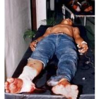 Uno de los heridos yace en una cama en un hospital de Cotabato
