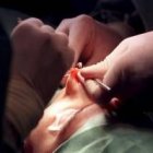 Una imagen de la realización de una rinoplastia para reconstruir el tabique nasal