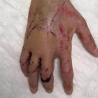 La mano de Bruno Hortelano, reestructurada por el doctor Xavier Mir.
