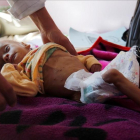 Un niño que sufre de desnutrición recibe tratamiento en un hospital de Saná, el 24 de noviembre.