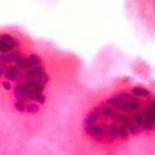 Células de un cáncer de mama metastásico observadas al microscopio.