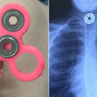 El Fidget Spinner y la radiografía en la que se aprecia la pieza del juguete en el esófago de la niña.