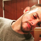 Àlex Casademunt muestra su rostro con múltiples heridas, tras sufrir una agresión el pasado 15 de enero en una discoteca de Vigo