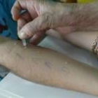 Una enfermera realiza las pruebas de la alergia a una paciente