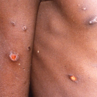 Entre los síntomas de la viruela del mono están las afecciones en la piel. DL
