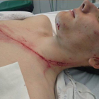 Andoni Azkarate con la herida que se produjo tras impactar con un guardarraíl en el Campeonato de Euskadi de ciclismo amateur.