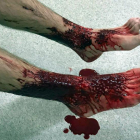 Las heridas en las piernas de Sam Kanizay, en un hospital de Melbourne (Australia).
