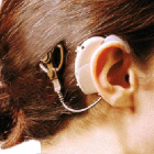 Implante auditivo aplicado por primera vez en España hace unos años.