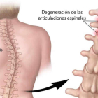 La escoliosis una deformación de la columna vertebral que en los casos leves suele estar infradiagnosticada. MAYO CLINIC NEWS NETWORK