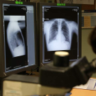 El 70% de los cánceres de pulmón se diagnostican en fases avanzadas. SECUNDINO PÉREZ