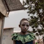 Lucie Habimana, de 13 años, tiene la cara cubierta con ungüento después de recibir tratamiento para el mpox en el Centro de Salud Munigi en Munigi, República Democrática del Congo, el 16 de agosto de 2024. El Centro Europeo para la Prevención y el Control de Enfermedades (ECDC) advirtió que es probable que Europa registre más casos importados debido a la propagación del virus en varias naciones africanas después de que la Organización Mundial de la Salud declarara la propagación del mpox en África como una emergencia sanitaria mundial. El mpox pertenece a la misma familia de virus que la viruela, pero causa síntomas más leves como fiebre, escalofríos y dolores corporales. EFE/EPA/MOISE KASEREKA