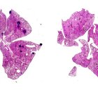 En la imagen de la izquierda: tumores de mama de ratón que  desarrollaron cáncer metastásico en los pulmones (zonas oscuras de la imagen), y en la de la derecha, la misma imagen limpia de metástasis en ratones que recibieron tratamiento con aspirina. Fotografía facilitada por Jie Yang. EFE