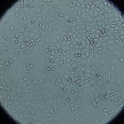 Una imagen al microscopio de las células tumorales de cáncer de páncreas. EFE/Crédito: Imagen cedida por el Hospital 12 de Octubre.