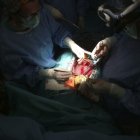 Fotografía de archivo de un trasplante de corazón.