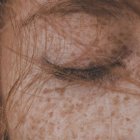 Manchas, estrías y una mayor sequedad pueden hacerse más evidentes cuando termina el verano y comienza a desaparecer el bronceado.