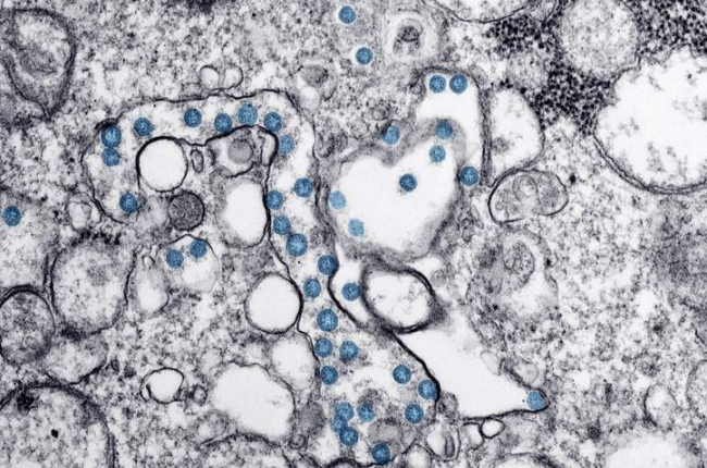 Partículas del virus SARS-CoV-2, coloreadas en azul, en una imagen de microscopio de electrones. CDC