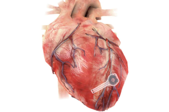 Ilustración del dispositivo sobre un corazón. Northwestern University