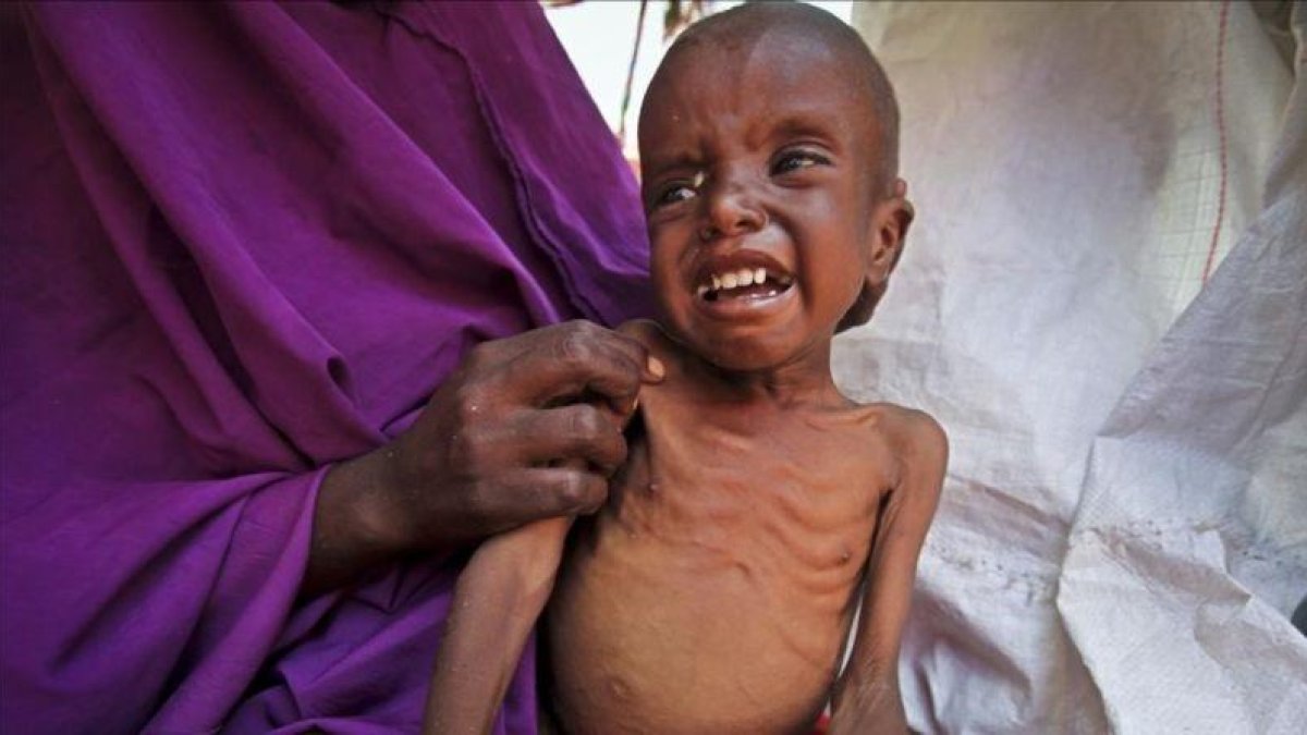 Un niño somalí de 7 años que padece malnutrición en el campo de desplazados de Garasbaley, a las afueras de Mogadiscio, la capital de Somalia.