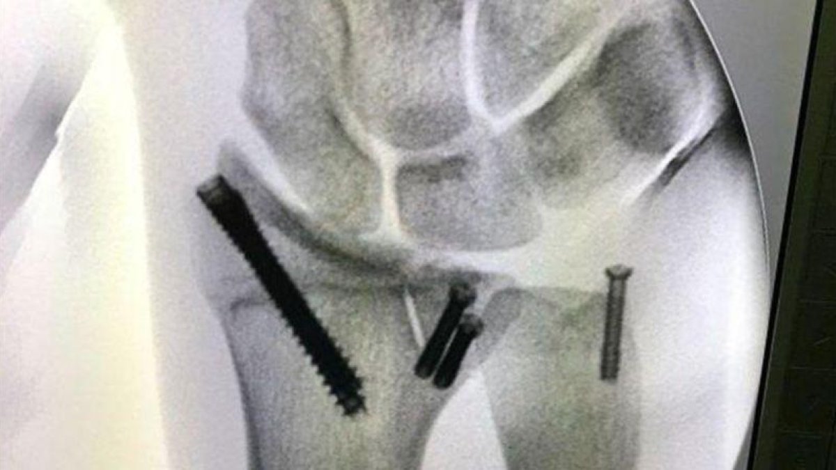 El doctor Xavier Mir ha reconstruido la muñeca izquierda de Joan Barreda con varios tornillos.