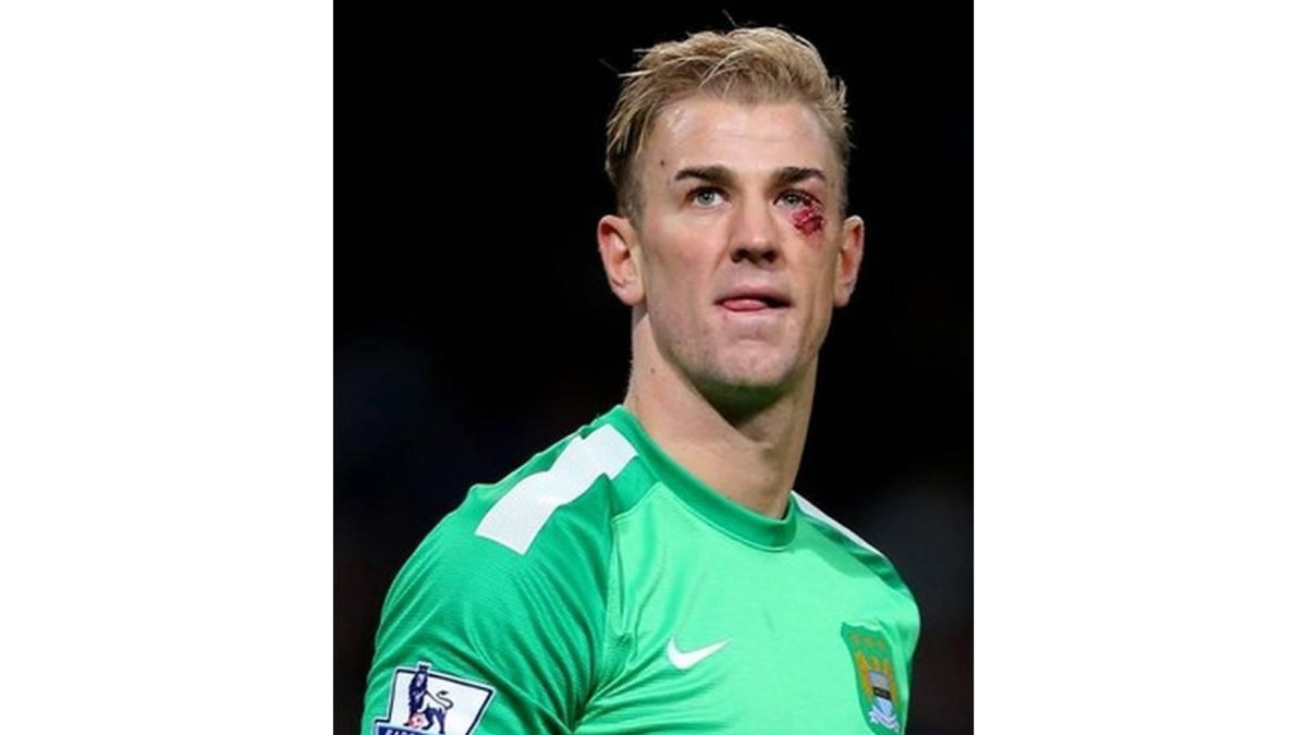 El portero del Manchester City Joe Hart, con un ojo morado producido por un choque con un jugador del Crystal Palace.