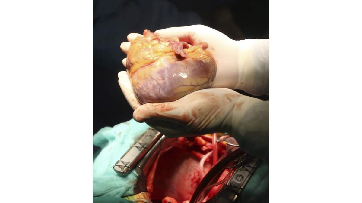 El corazón infartado tiene dos reacciones edematosas. SALAS