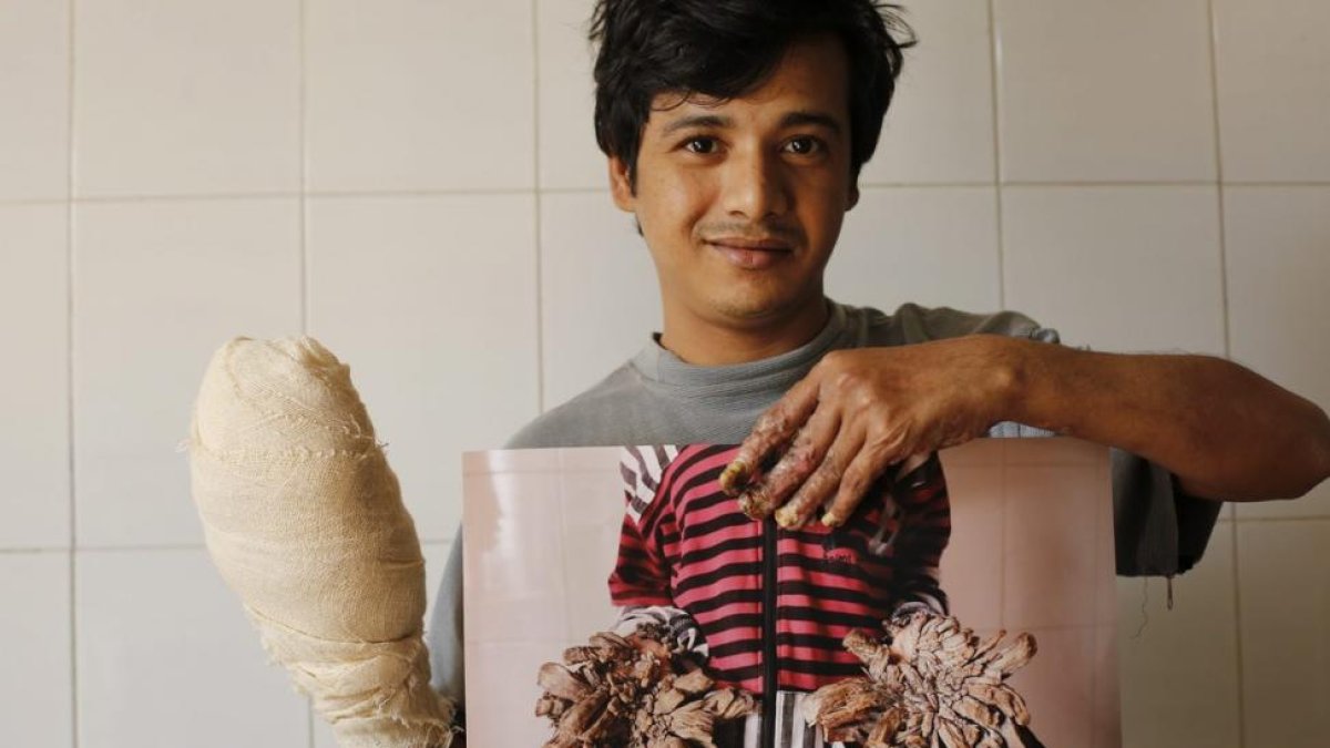 Abul Bajandar muestra una fotografía de cómo estaban sus manos antes de someterse a 16 operaciones en el Dacca Medical College en Bangladesh.