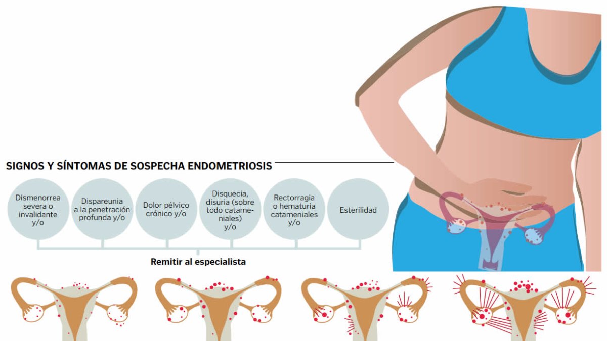 Endometriosis