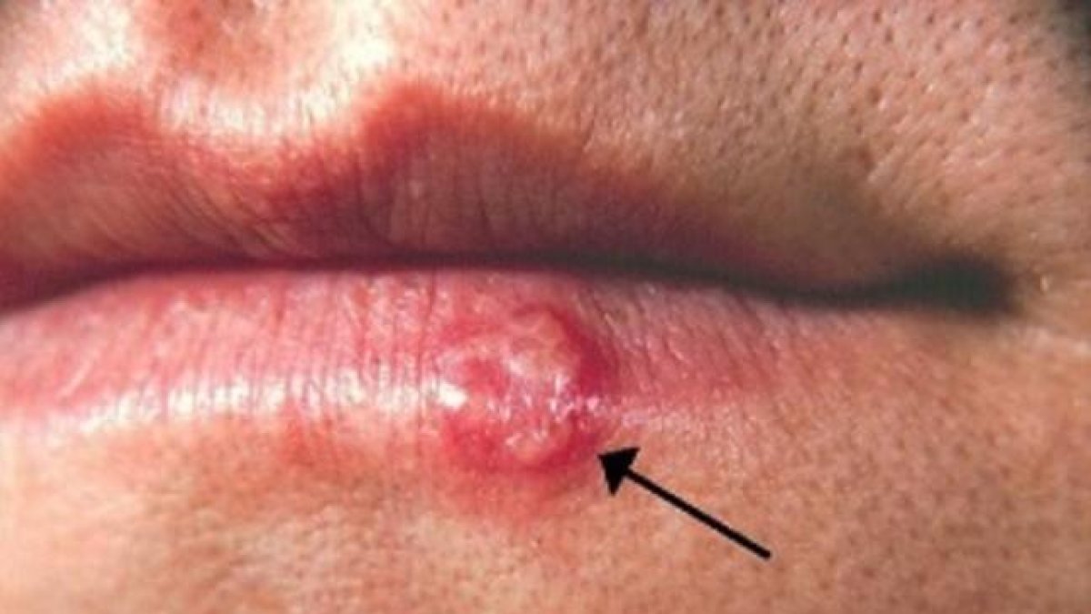 Herpes labial, causado por el virus simplex de tipo 1 (HSV-1)