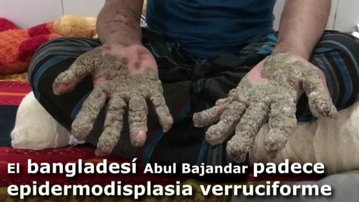 Abul Bajandar se hizo mundialmente conocido por las grandes verrugas que cubrían su cuerpo y que le llevaron a ingresar hace hoy dos años en un hospital de Dacca.