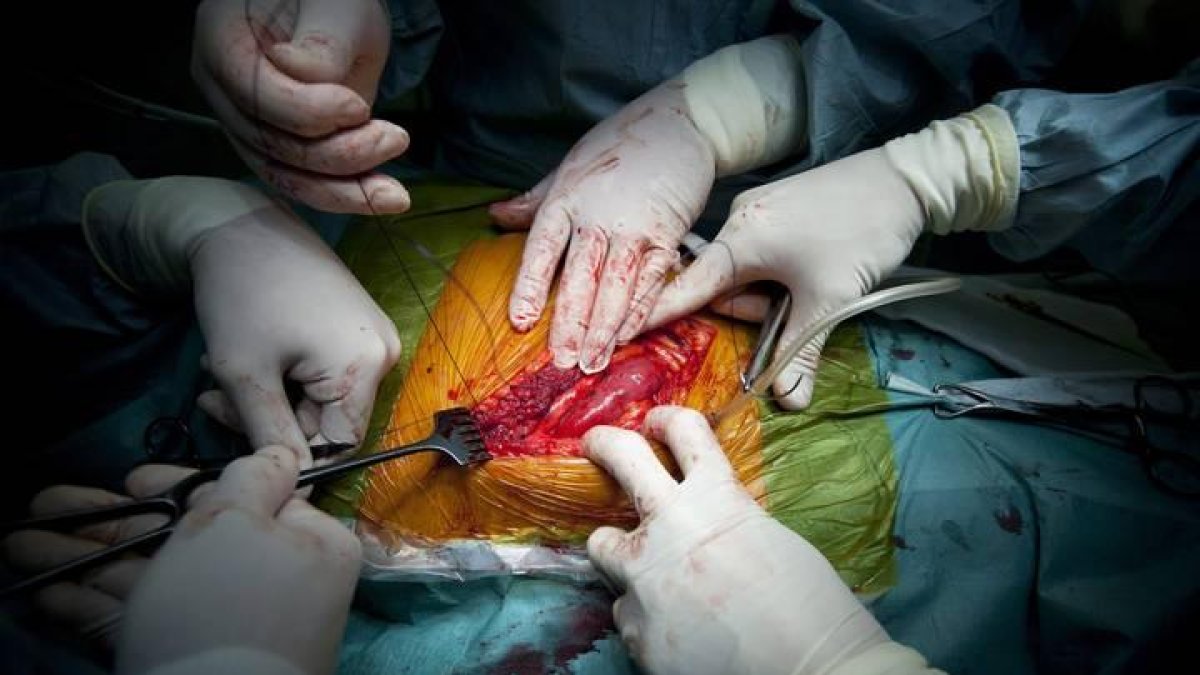 Varios cirujanos trabajan en una operación de transplante de riñón de un donante vivo