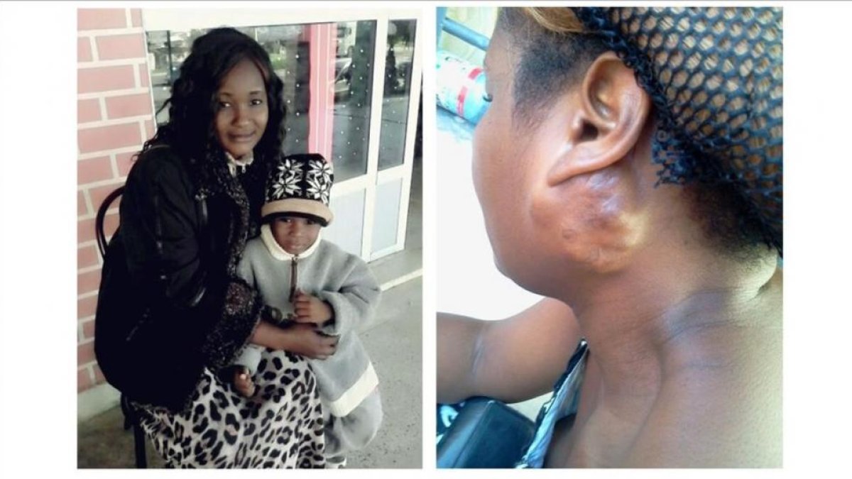 Veronique, con su hijo Samuel, y detalle del tumor que la mujer tenía en el cuello.
