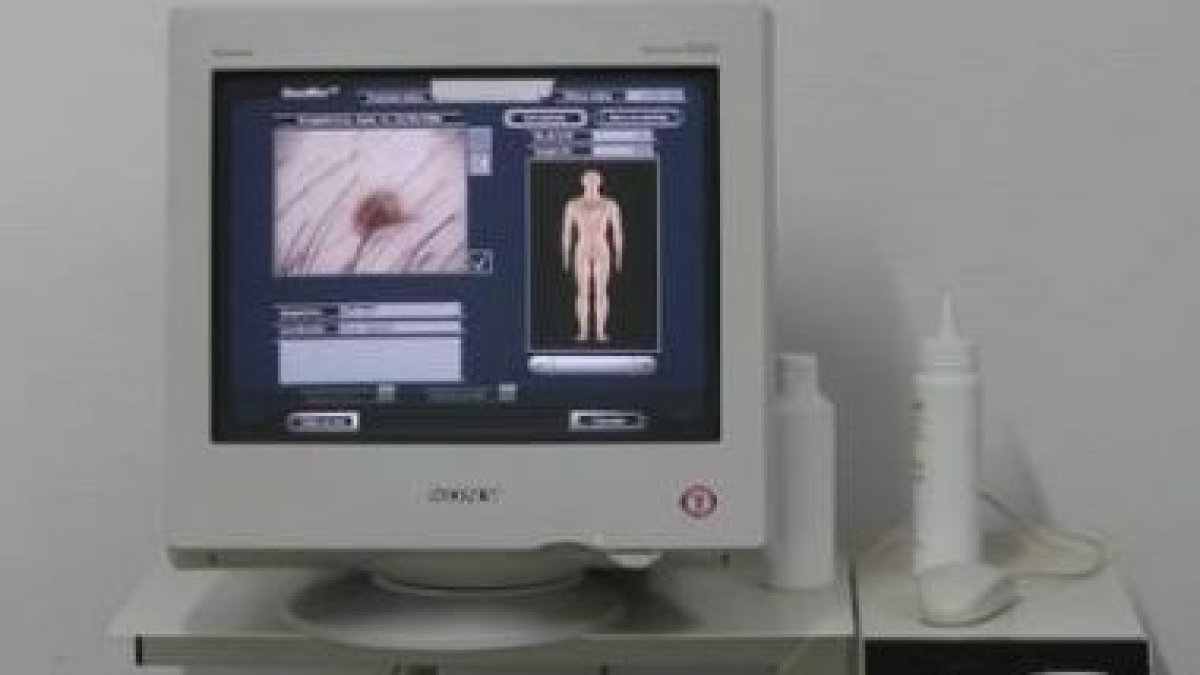 La dermatoscopia digital, método de diagnóstico precoz.