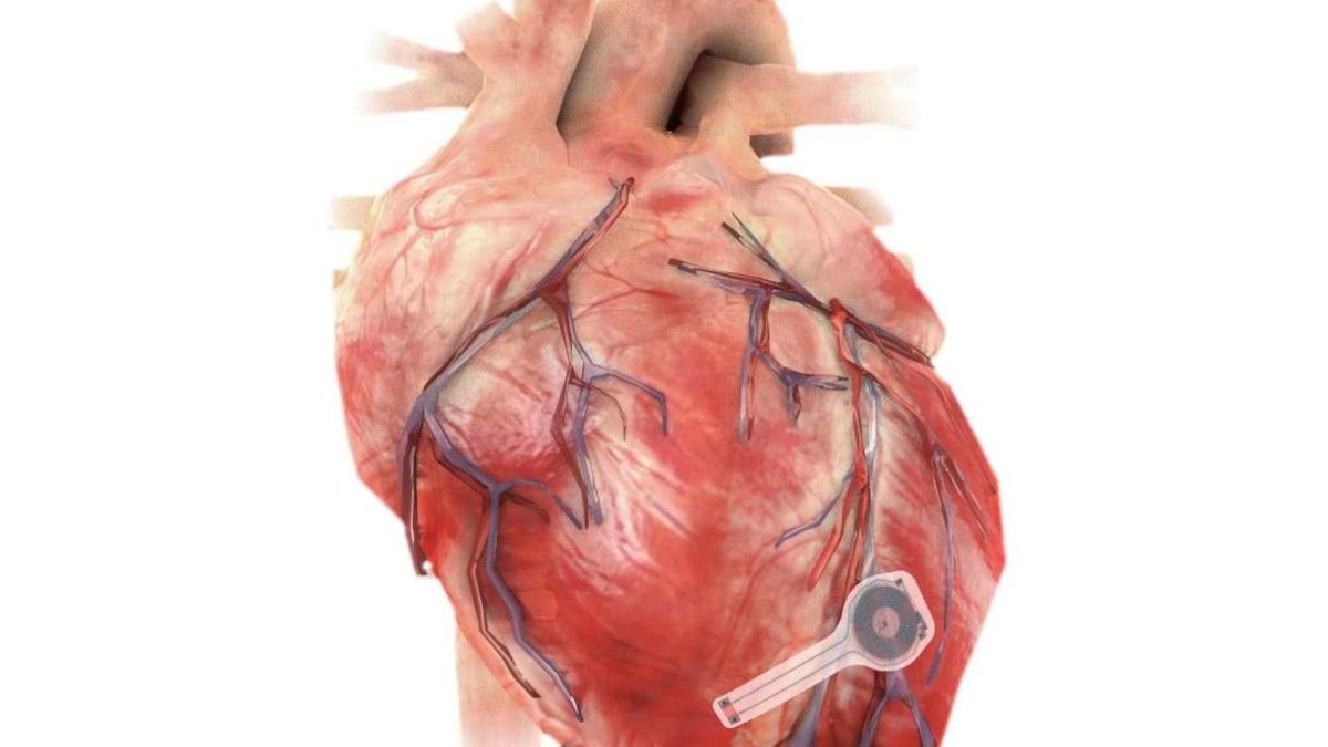 Ilustración del dispositivo sobre un corazón. Northwestern University