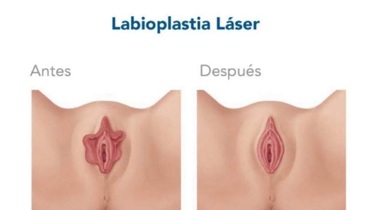 Imágenes que ilustran el antes y el después de una labioplastia y el uso del láser para intervenir en la zona genital. CENTRO GINECOLÓGICO HM SAN FRANCISCO