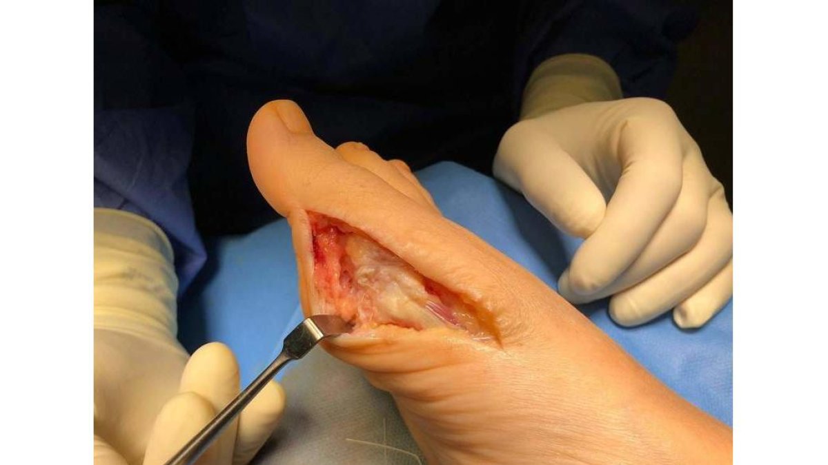 Un pie recién operado de Hallux valgus o juanete. UNIDAD DE PIE Y TOBILLO CAULE