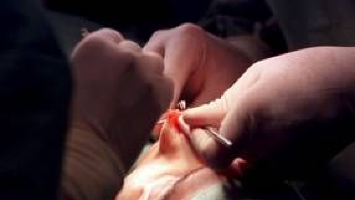Una imagen de la realización de una rinoplastia para reconstruir el tabique nasal
