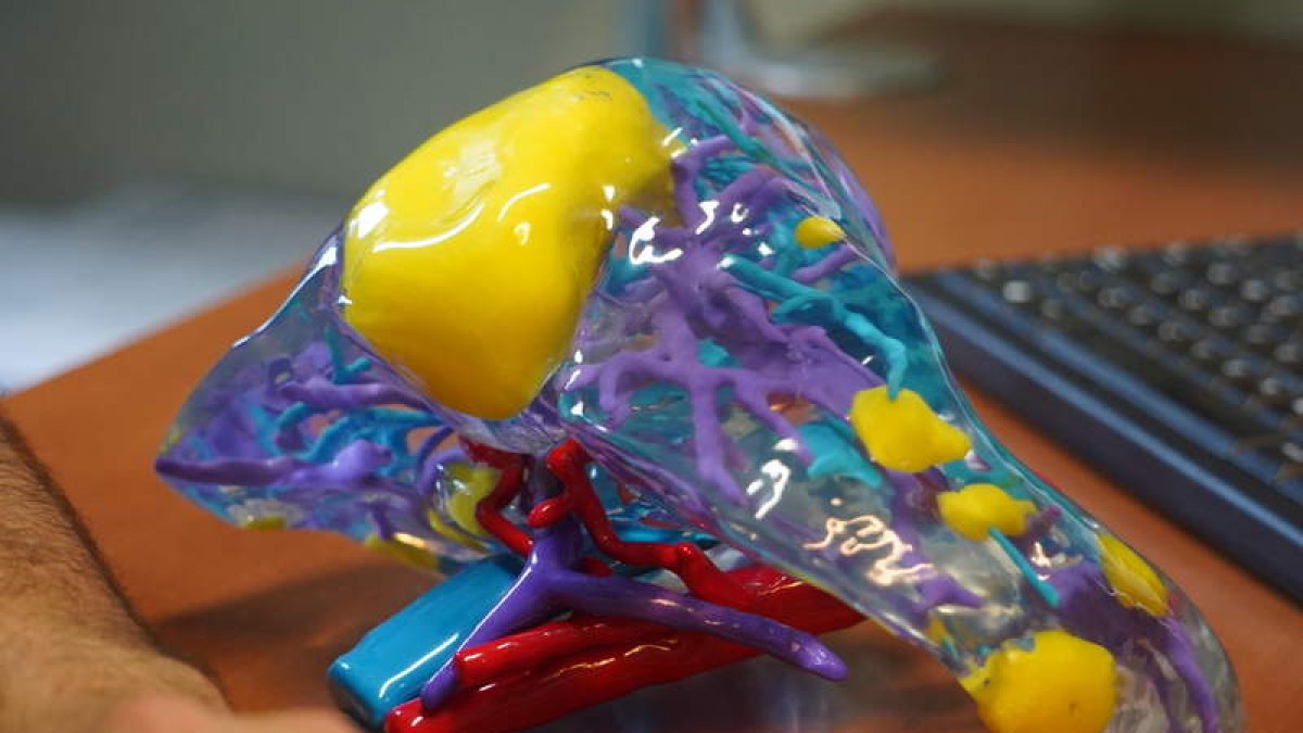 Un modelo en 3D de un hígado enfermo. J. NOTARIO