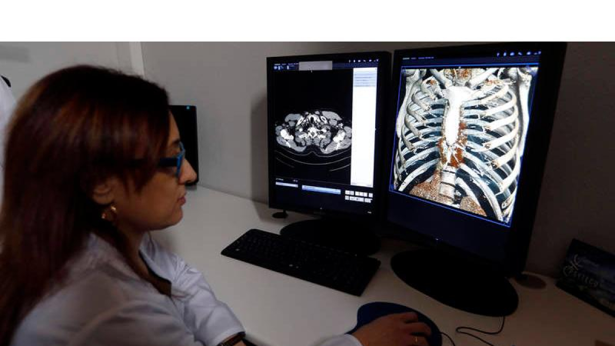 Imagen de unos pulmones en la clínica Santa Ana de León. MARCIANO PÉREZ